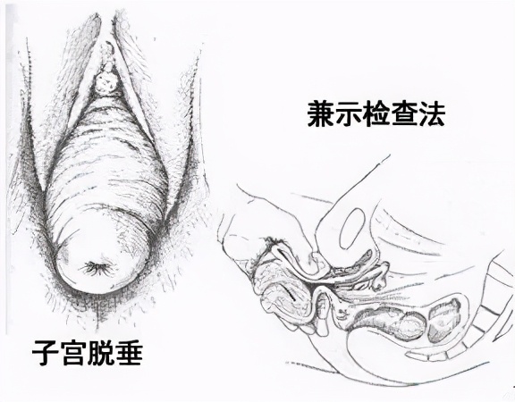 七旬老妪的难言之隐，其实可以这样预防