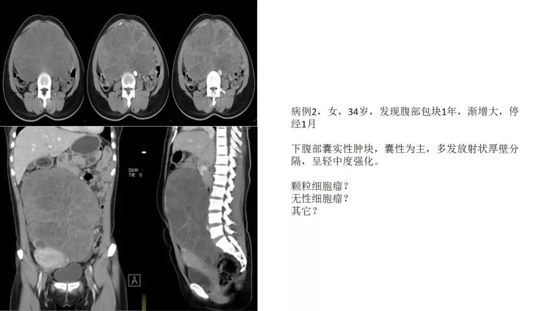 卵巢原发肿瘤的分析思路