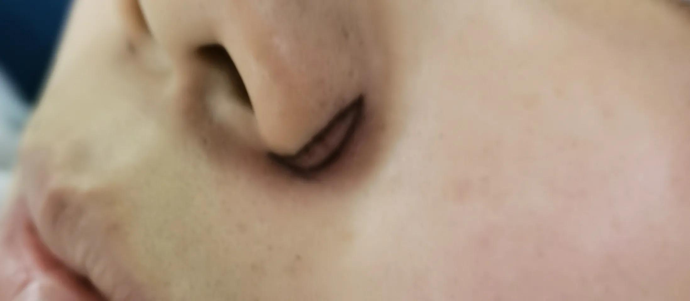 整形医生做面部美容视频,鼻头鼻翼缩小术的真实案例