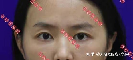 可以只开眼角不割双眼皮吗,双眼皮到底要不要开眼角