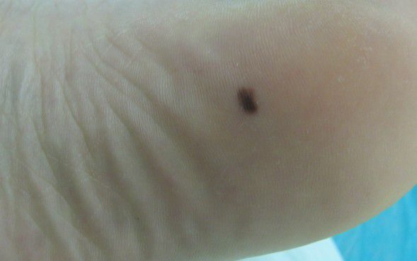 色素痣怎么治疗最为稳妥,色素痣如何知道是否癌变