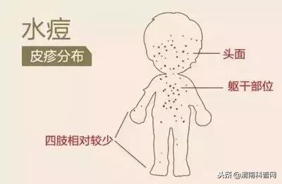 水痘基本知识图解,学校水痘的防控措施