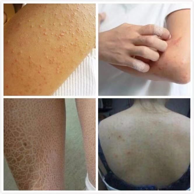 冬天皮肤干燥起皮屑用什么护肤品,一到冬天脸部干燥起皮补什么