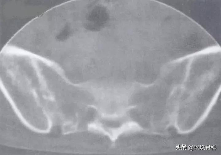 5岁小孩强直性脊柱炎的诊断,强直性脊柱炎诊断标准b27