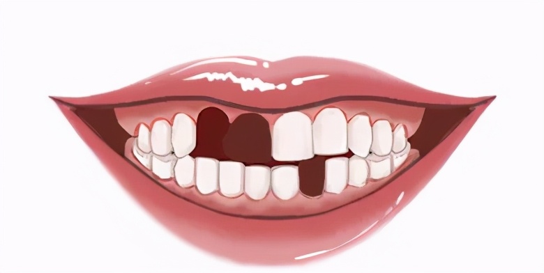 种牙真实过程,种牙是拧螺丝吗