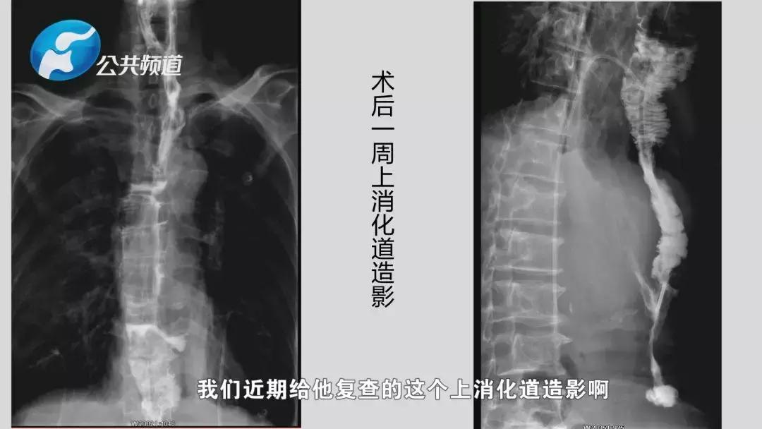 拼搏亮剑|河南大学第一附属医院胸腔镜辅助食管癌根治横结肠代食管手术纪实