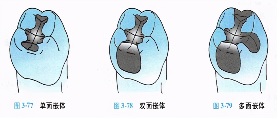 牙科嵌体的处理,牙科医生讲义