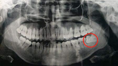 拔牙后经历的几个阶段,拔牙前的恐惧与拔牙后的舒适