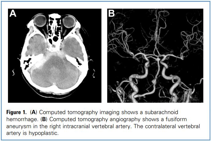 盖延廷大动脉瘤复查,夹层动脉瘤支架治疗
