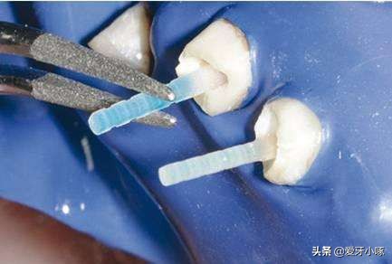 小洞不补大洞受苦早发现早治疗,为什么说牙齿小洞不补大洞吃苦