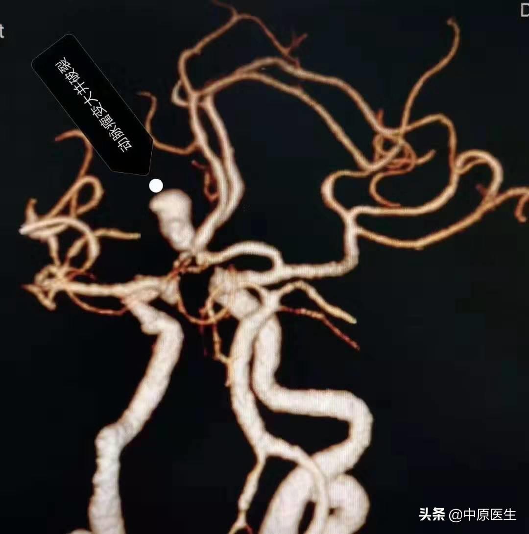 大脑双侧动脉瘤,发现脑内有两个瘤医生说不管