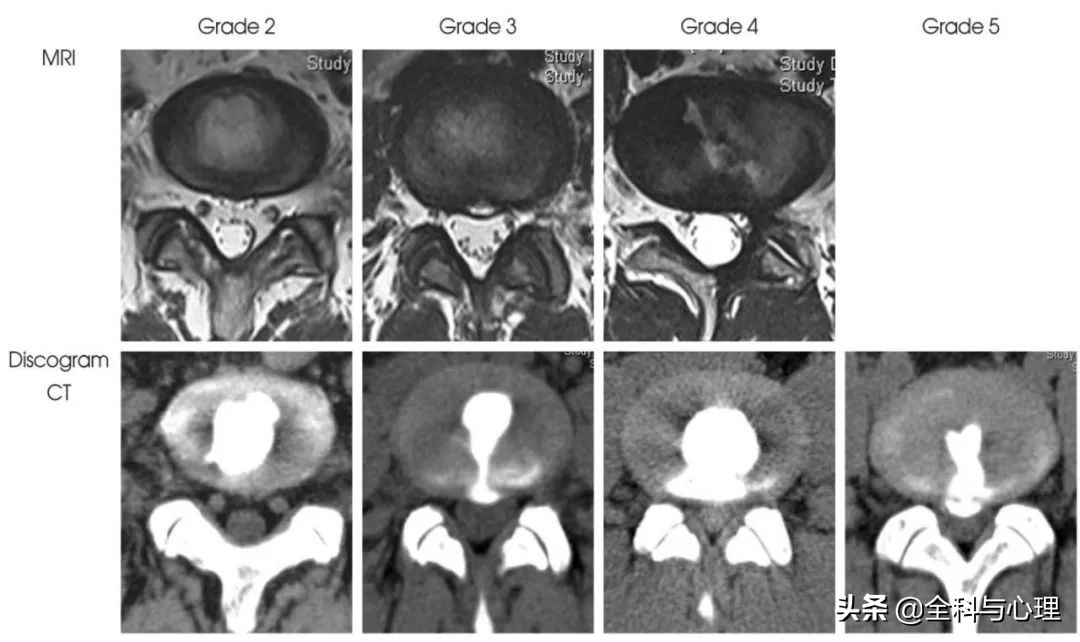 腰痛要警惕四种原因肾不好,盘点腰痛常见病因及防治训练