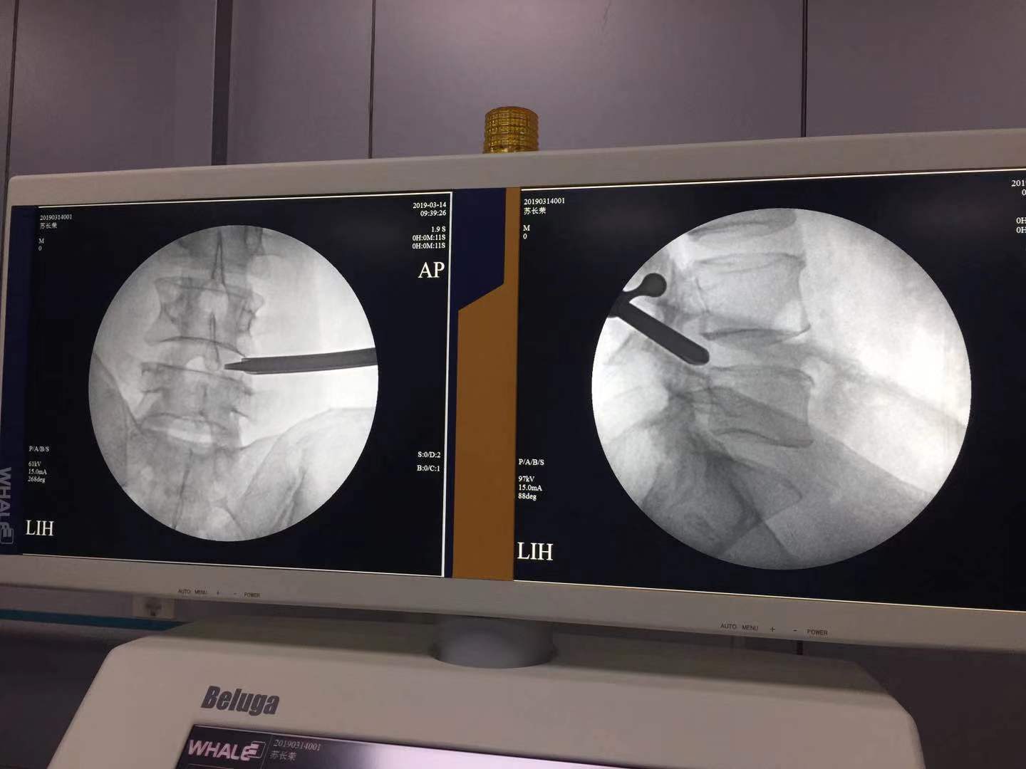 微创埋线治疗腰腿疼,腰腿疼怎么保守治疗