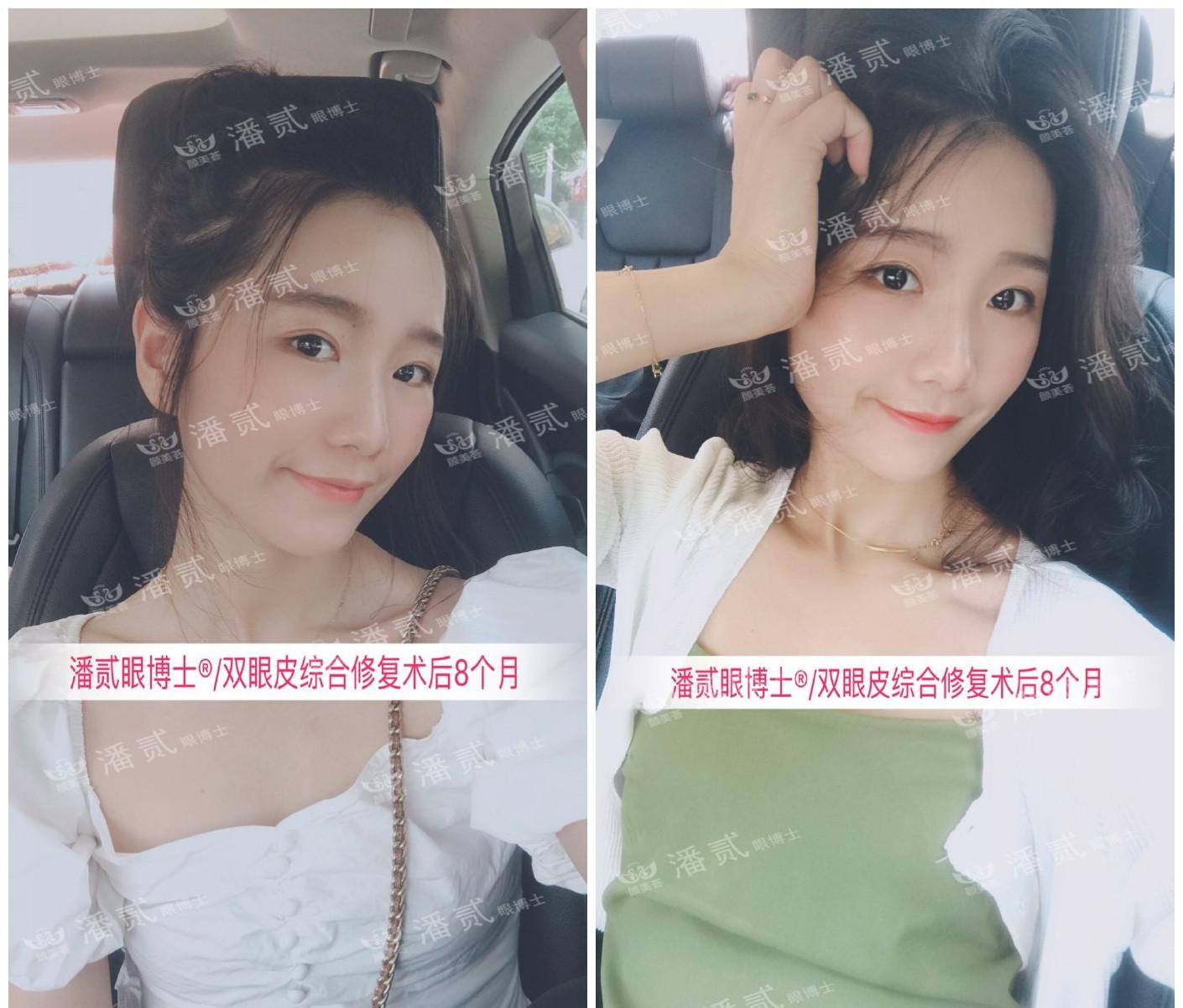 双眼皮整容失败眼皮跳动,双眼皮整形失败修复还花钱吗