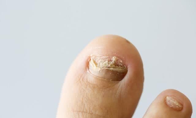 怎么避免灰指甲再次复发,怎样根除灰指甲的真菌