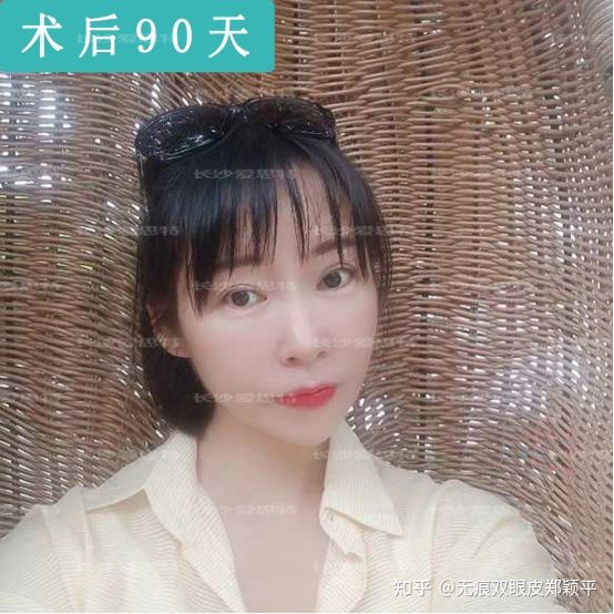 刚割双眼皮的样子,割双眼皮增生是什么样子