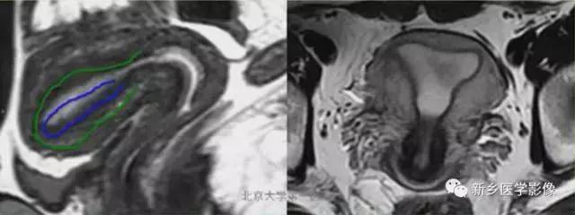 子宫发育异常,应想到的6大类常见畸形
