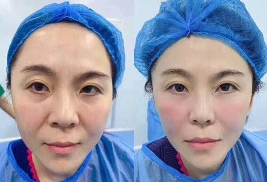 纹唇后第8天可以涂口红了吗,纹唇的效果能和涂口红一样吗