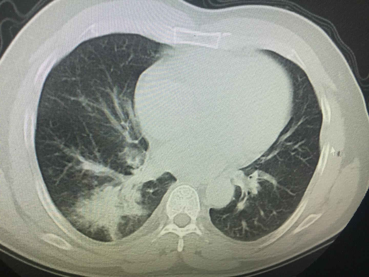 发现痰中带血是肺癌几期,回吸痰中带血是什么原因