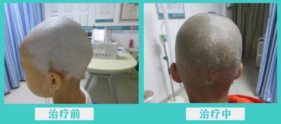 小女孩得白斑要注意什么,小女孩患有罕见疾病