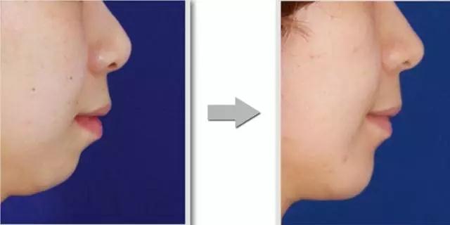 为什么有的人做隆鼻显老,为什么普通人做假体隆鼻不好看