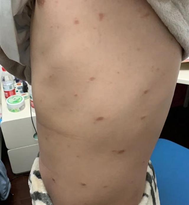 中医治疗皮肤痒的最好方法,中医治疗皮肤纤维瘤