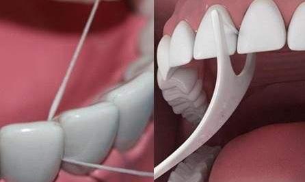 不洗牙去除牙结石的实用方法,牙结石特别严重如何洗牙