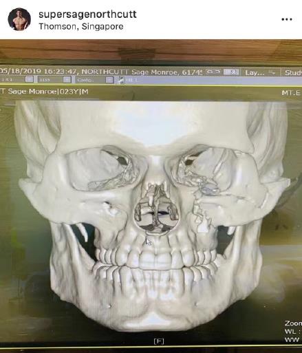 太狠了！一拳下去竟然碎了8块脸骨！