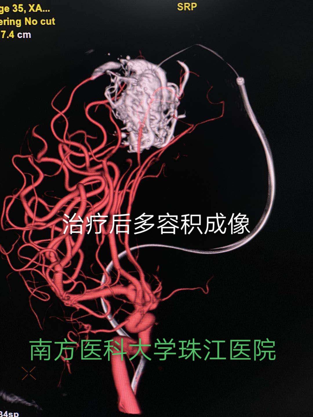 脑动静脉畸形可选用的栓塞物,脑动静脉畸形做伽玛刀后康复