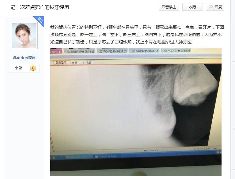 拔智齿是怎么算收费的,拔智齿是按智齿个数收费吗