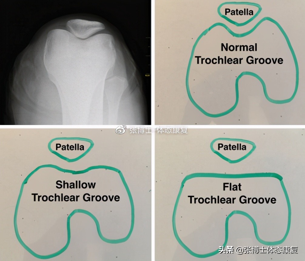 髌骨关节疼痛综合症怎么治,髌骨疼痛综合症的辅助疗法