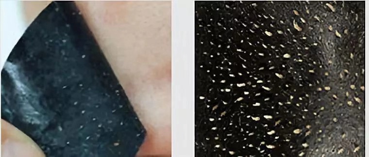 一秒去黑头去粉刺,一步就能搞定的黑头