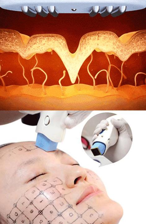 拉皮手术的四大优势,拉皮手术热议