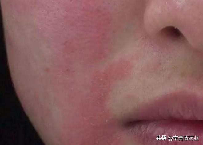 面部皮炎用什么药治疗效果最好,治疗脂溢性皮炎不含激素的药膏