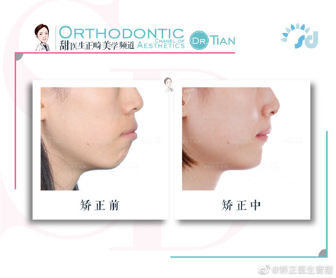 西安哪里有做牙齿矫正,在西安哪里可以做牙齿矫正