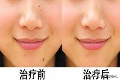 激光点大痣视频过程,脸上激光祛痣安全吗