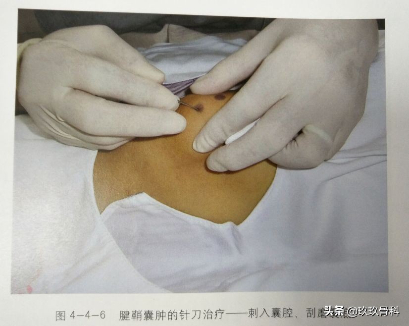 腱鞘囊肿针刺技巧视频,手指腱鞘囊肿正确挤压方法视频