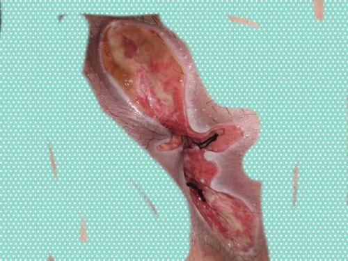 肛瘘手术比生孩子还痛吗,做完肛瘘手术疼痛怎么解决