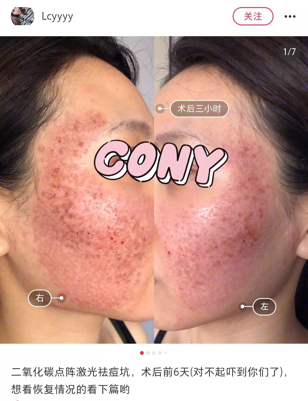 挤痘进了ICU，连下两次病危通知？这痘痘到底还能不能挤！