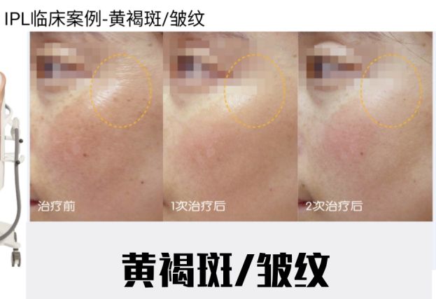 哪种医美项目祛痘印最有效,最有效的医美抗衰项目