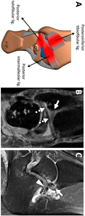 伸直后腿筋疼是怎么回事,前脚踝撞击综合征怎么治疗