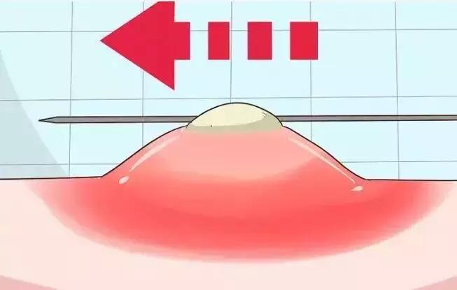 挤了个痘痘进icu,挤痘痘昏迷了