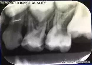 儿童换牙注意事项换牙顺序看这里,换牙期的小朋友注意什么