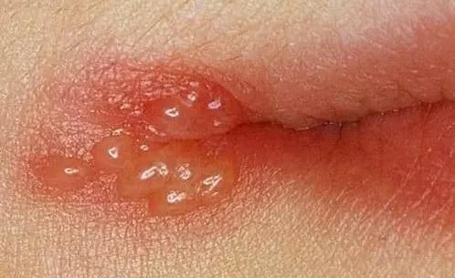 口唇疱疹好了上嘴唇又起泡结黄痂,嘴角疱疹和上火长泡的区别