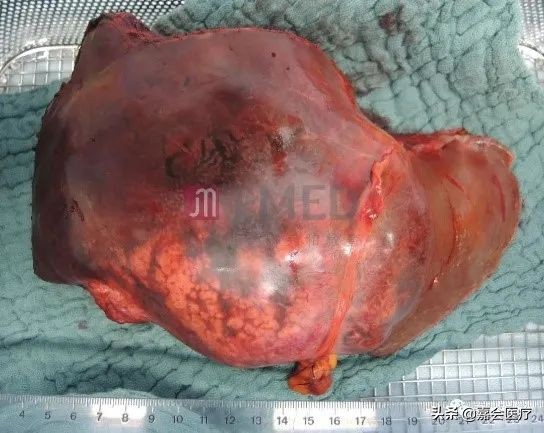 7mmx5mm肝癌能治愈吗,巨大型肝癌的治疗方法