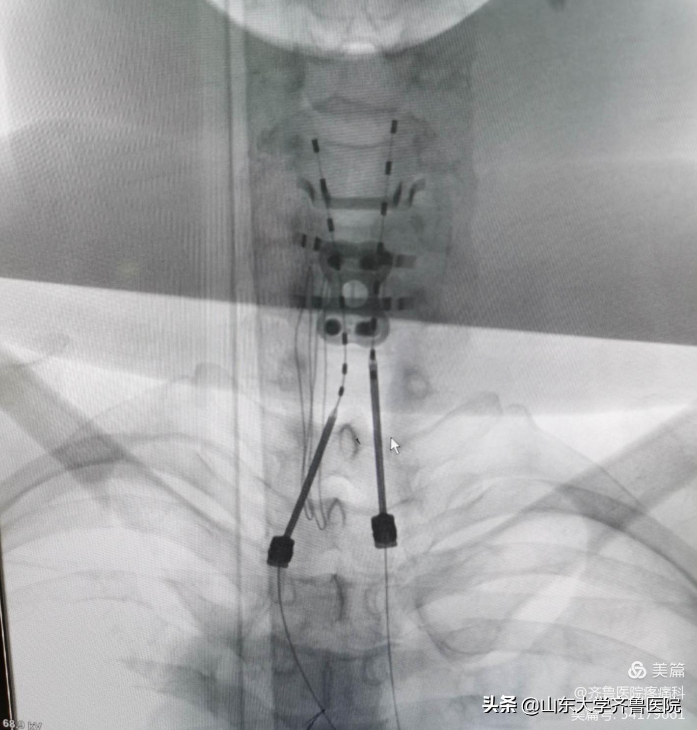 疼痛门诊怎么治疗颈椎压迫脊髓,山东齐鲁医院颈脊髓损伤手术专家