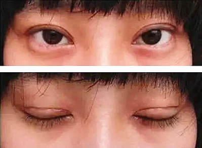 双眼皮疤痕凸起怎么回事,双眼皮两只眼睛疤痕不一样