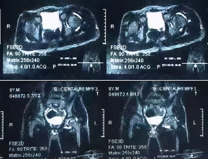 髋关节滑膜炎中药方,髋关节滑膜炎儿童