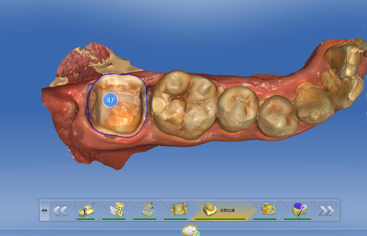 补牙补次数多了洞会越来越大吗,补牙补几次能补完