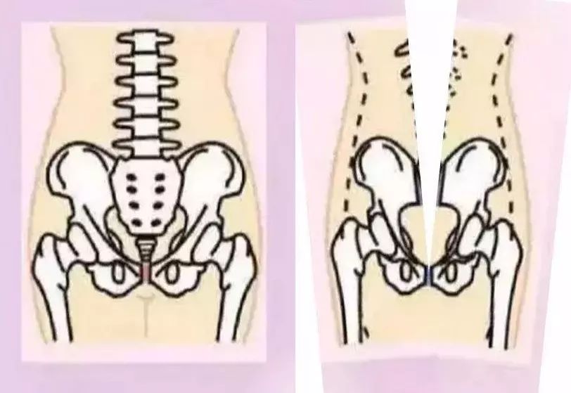 骨盆修复手法是不是智商税,做骨盆修复到底是不是智商税